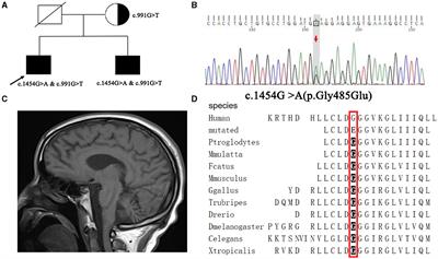 A novel variant of PLA2G6 gene related early-onset parkinsonism: a case report and literature review